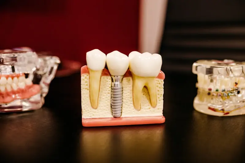 Modelo anatômico de dente com implante dentário de precisão